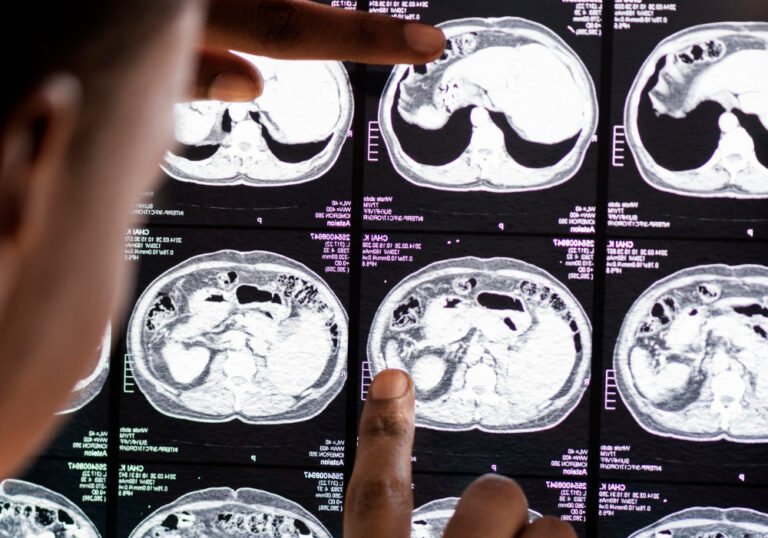 Maior causa de morte no país, AVC exige prevenção e socorro rápido